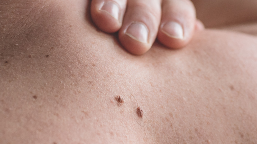 Twin moles on person's back 