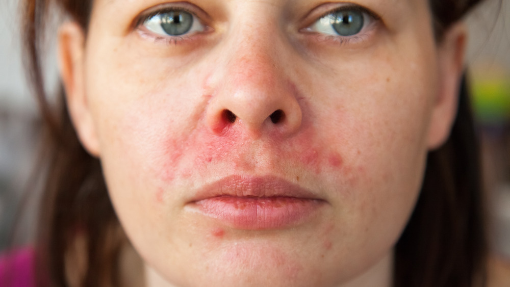 woman with perioral dermatitis