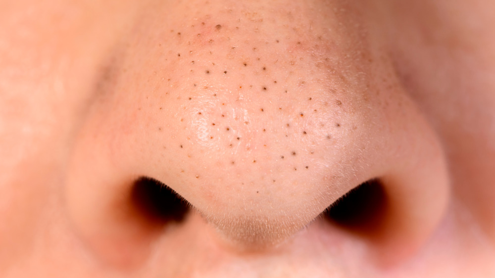 blackheads on nose