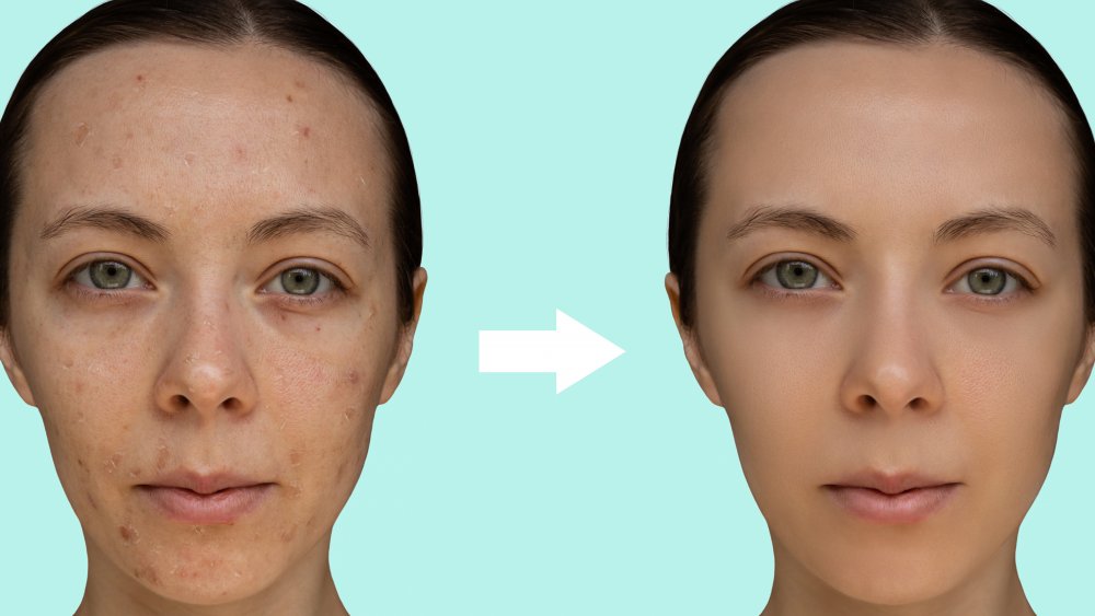 chemical peel