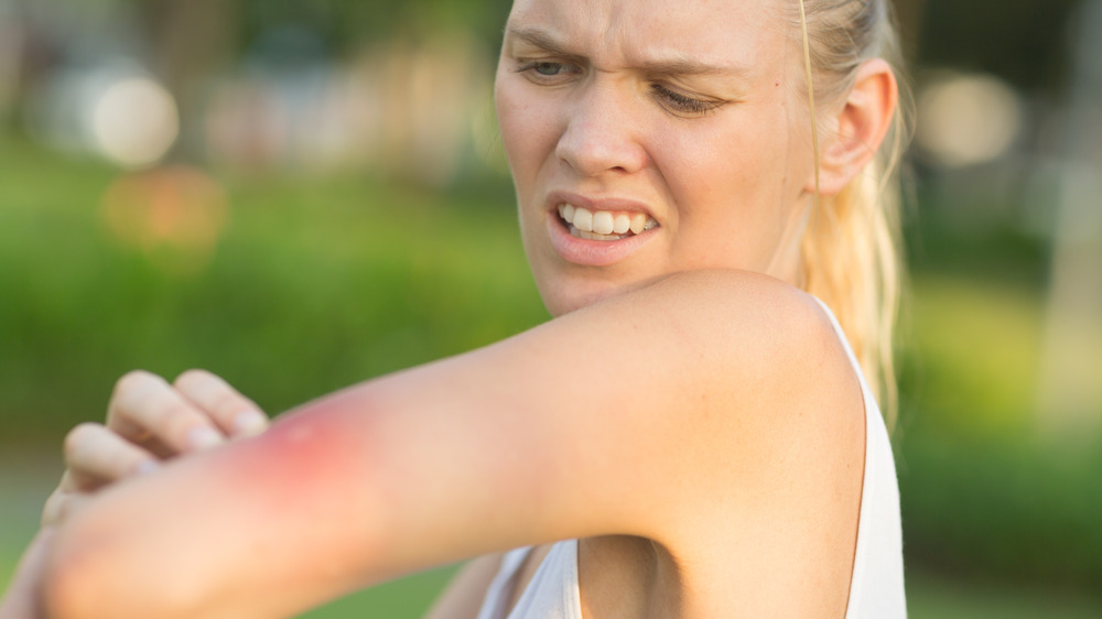 Irritated young blonde woman scratching a bug bite on her arm