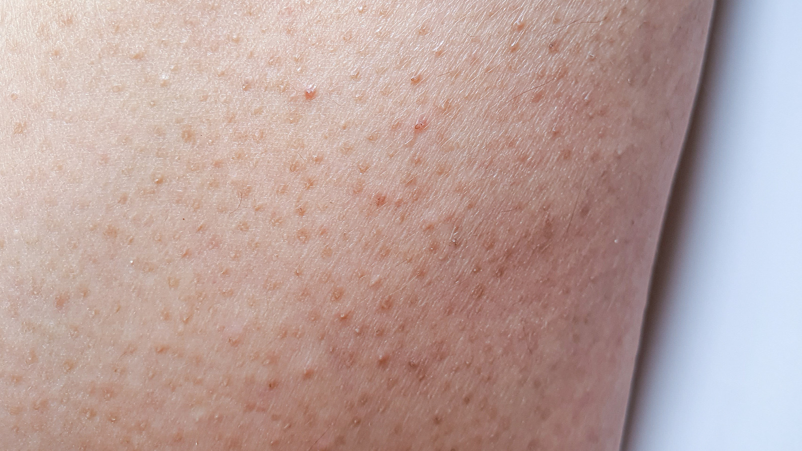 Heres Why You Have Little Bumps On Your Arms
