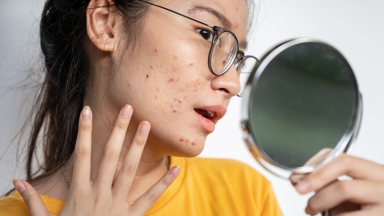 Woman with severe acne