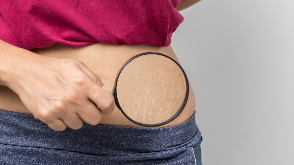 A woman holding magnifying glass to stretch marks