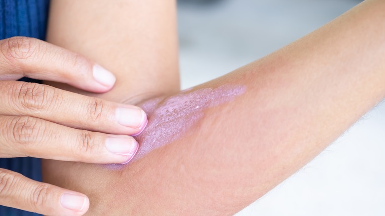 Calamine lotion on arm