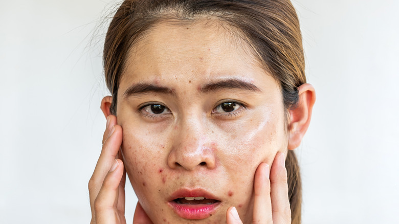 A woman struggling with sebaceous filaments