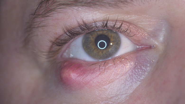 Person with a stye 