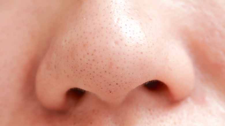 Blackheads on nose 