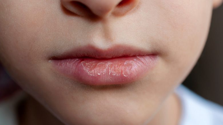 closeup of chapped lips