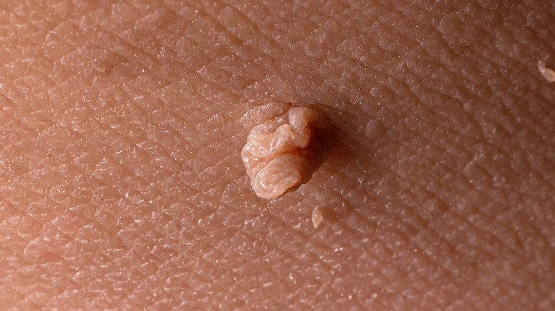 Skin tags