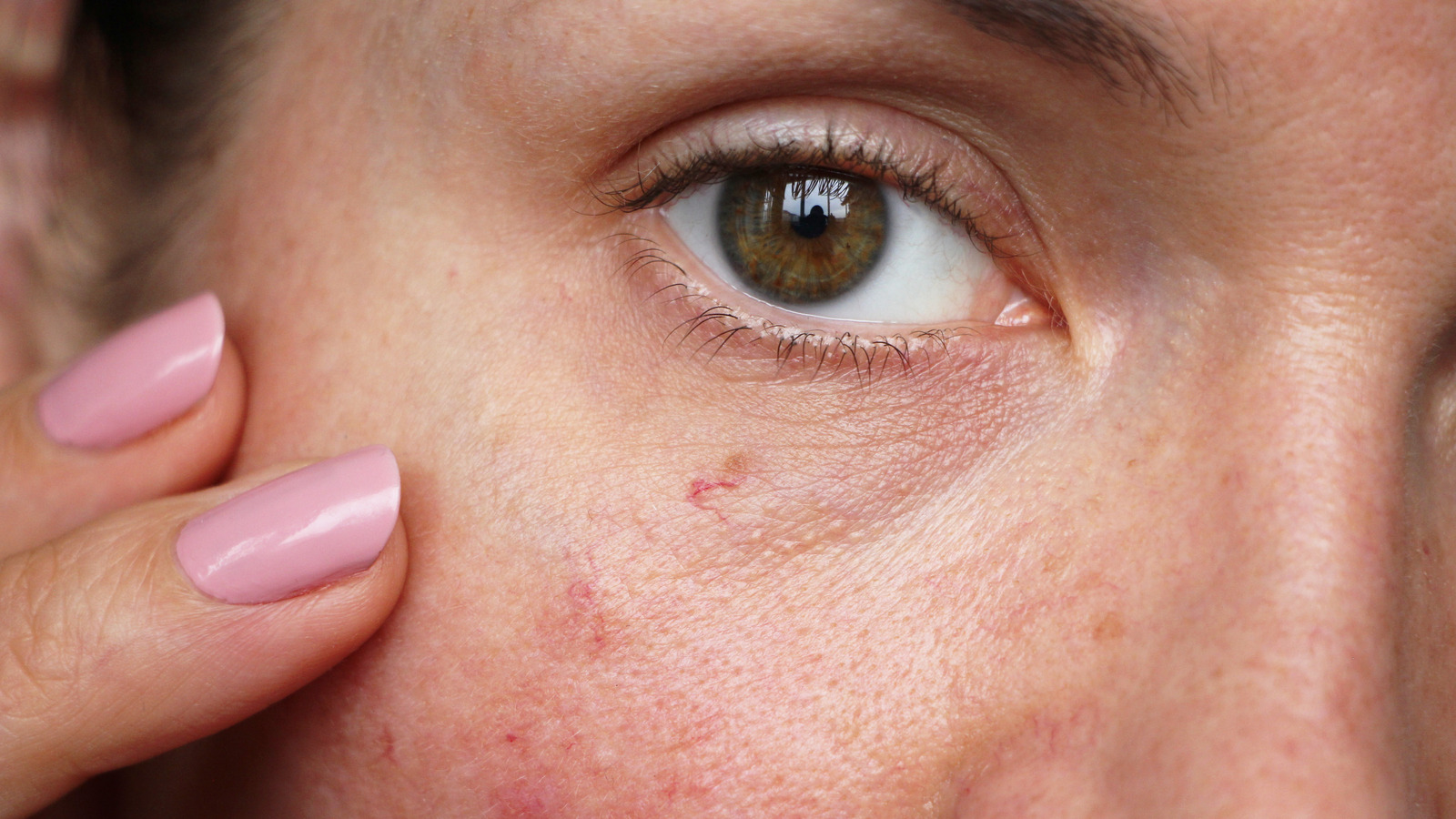 how-to-get-rid-of-spider-veins-on-your-face