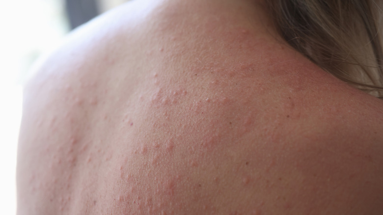Woman with sun rash on back 