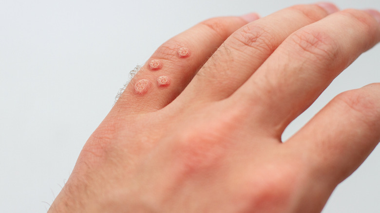 Warts on a hand