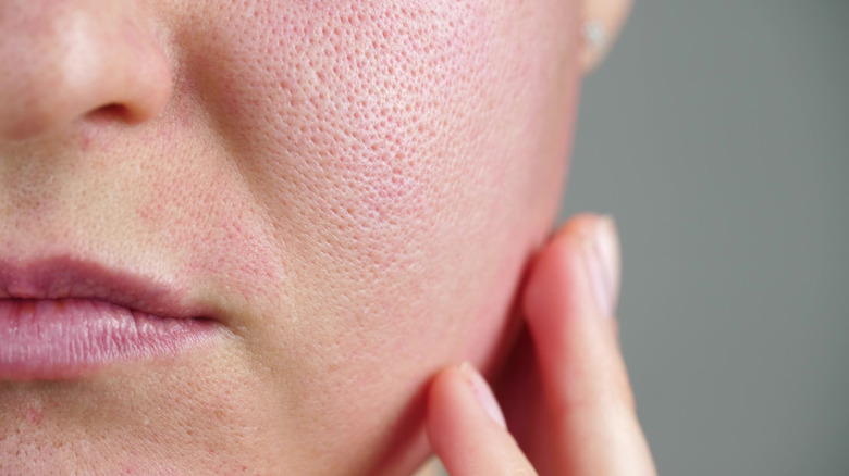 Close-up of enlarged pores