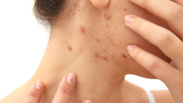 Woman with neck acne, touching her skin