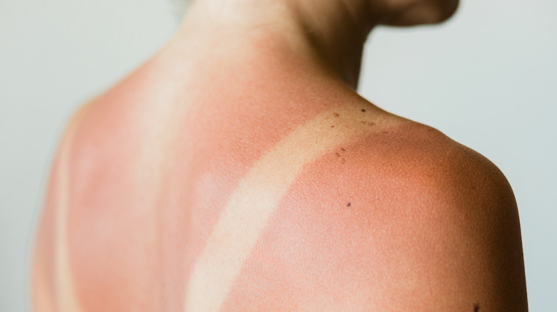 Woman with sunburnt back