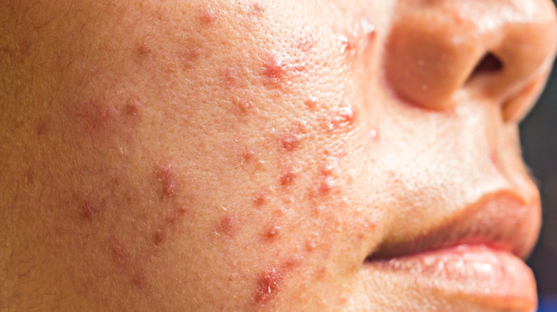 Woman with cystic acne on her cheeks 