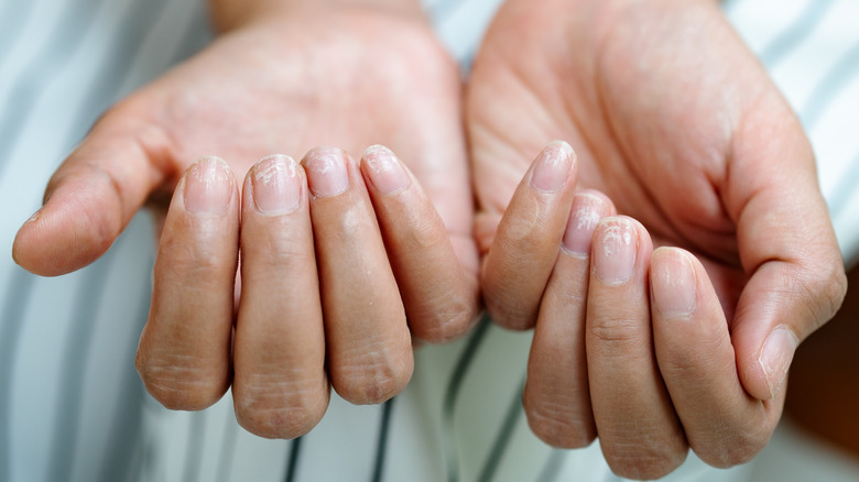 closeup of peeling nails 