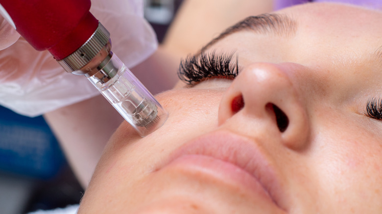 A woman having her microneedling treatment.