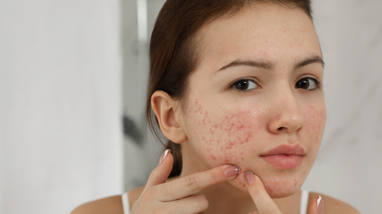 Teenage girl with pimples