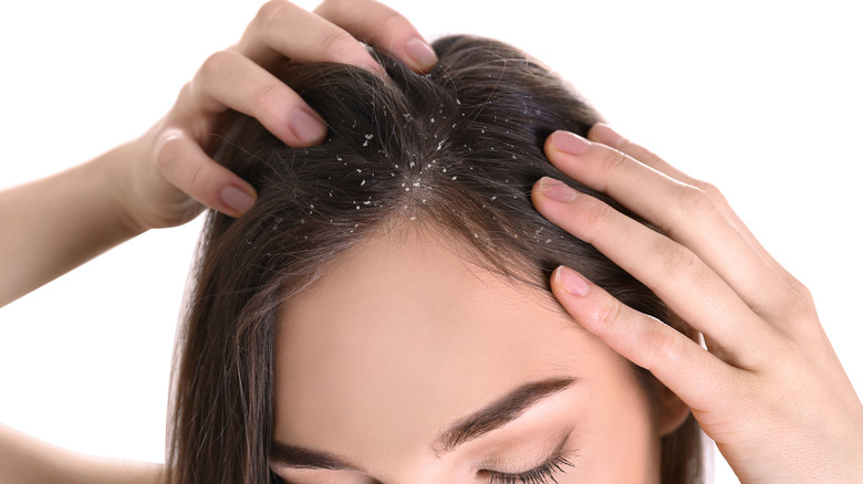 Brunette woman scratching her flaky scalp.