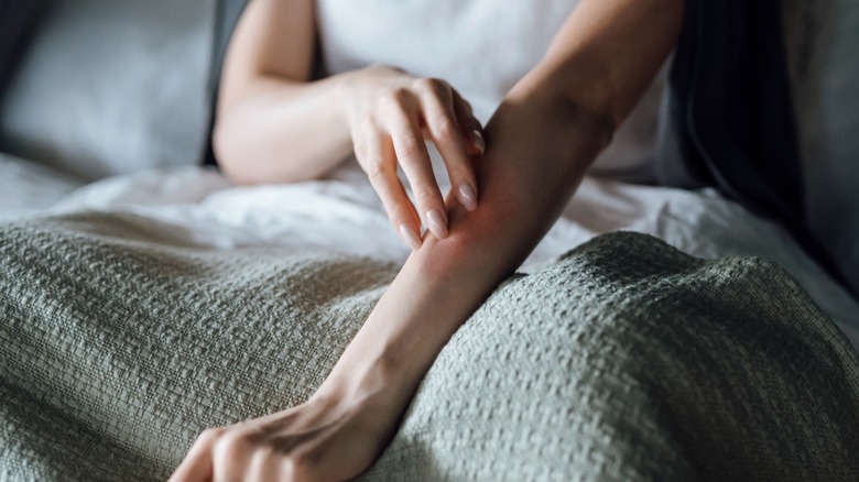 Closeup of woman with eczema