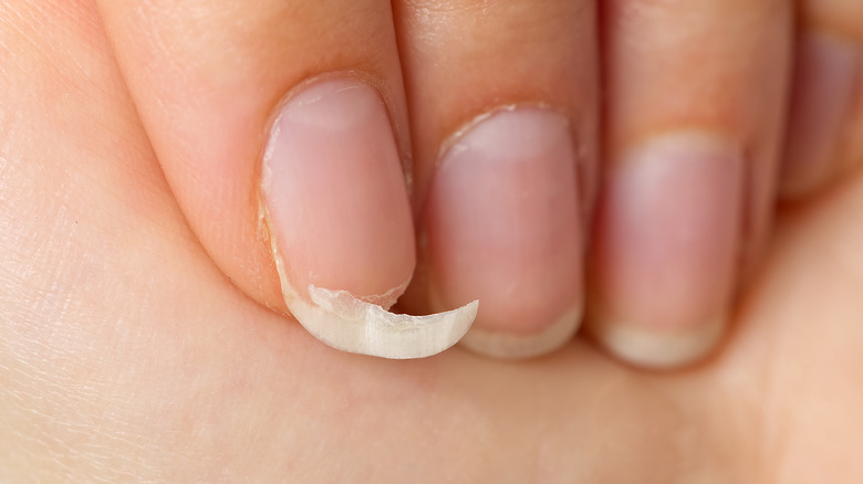 Broken fingernail