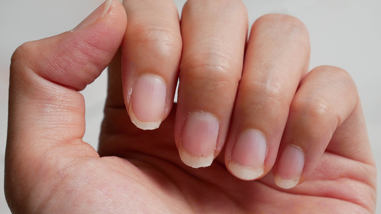 Hand with brittle nails