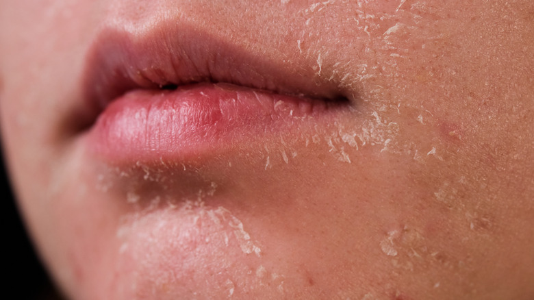 Close up of skin after chemical peel