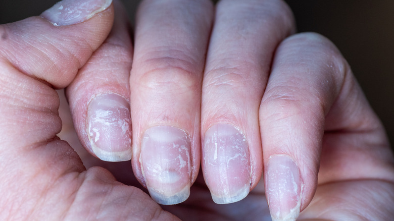 Peeling nails