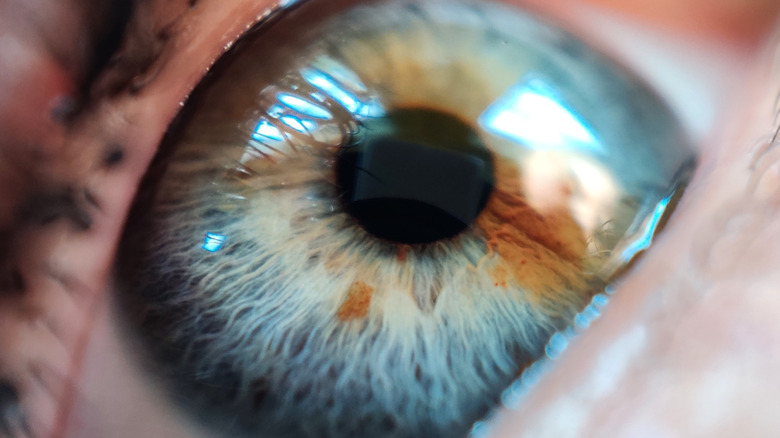 An eye with heterochromia
