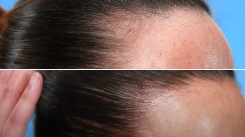Hairline Tattoo in Brisbane is an Ideal Solution for People  Soma