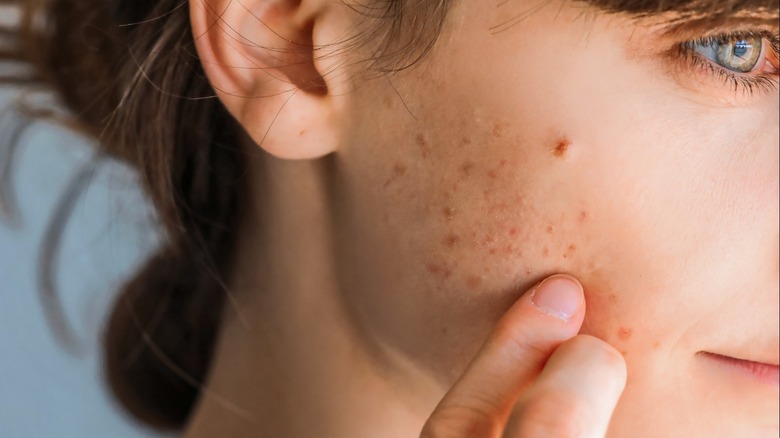 Woman with acne on cheek