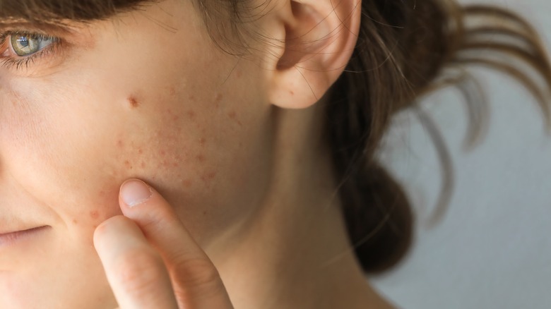 Woman with acne on her cheeks 