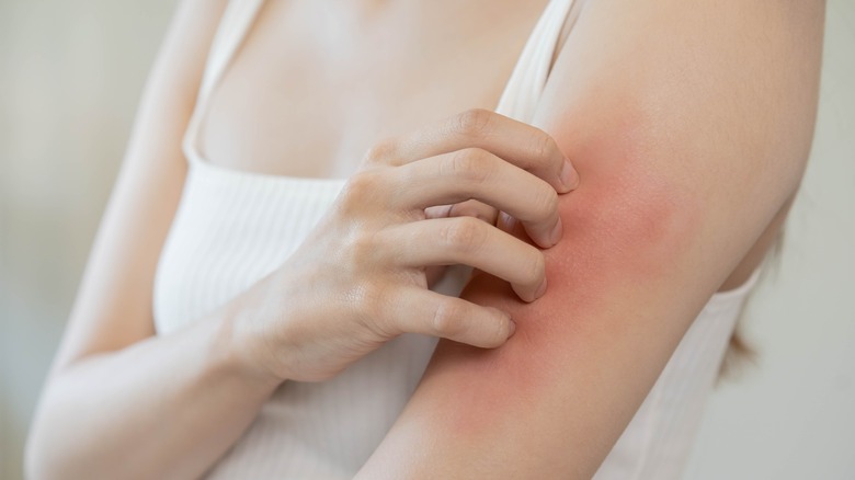 A person scratching dry, red skin 