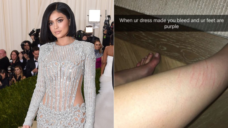 Kylie Jenner bruised after 2016 Met Gala