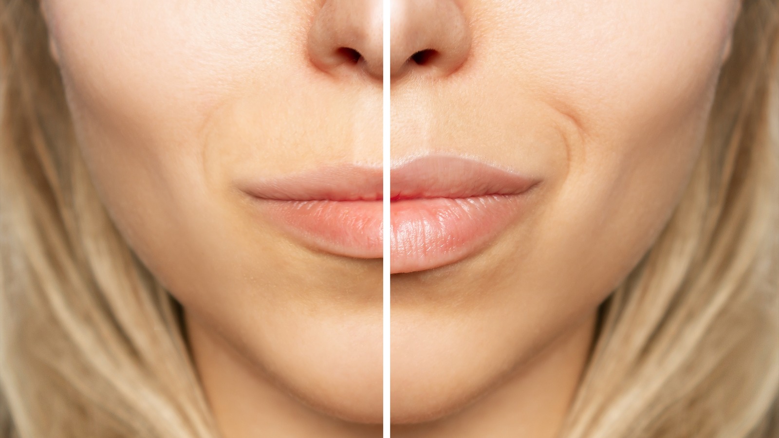 Lip Lift Vs. Lip Flip What's The Difference, And Which Is Right For You?