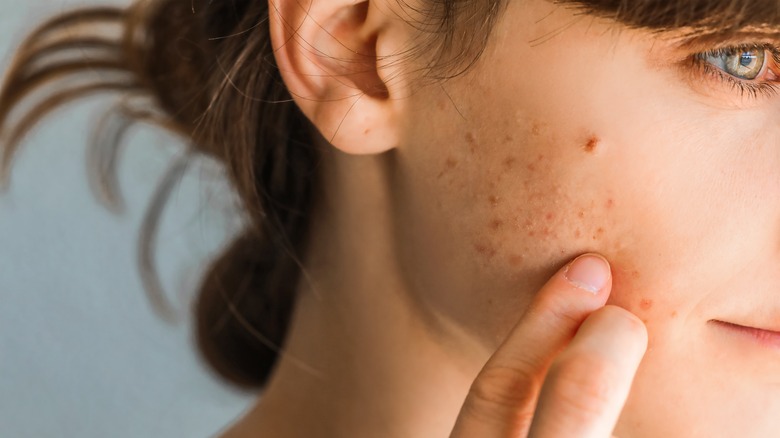 woman with facial acne