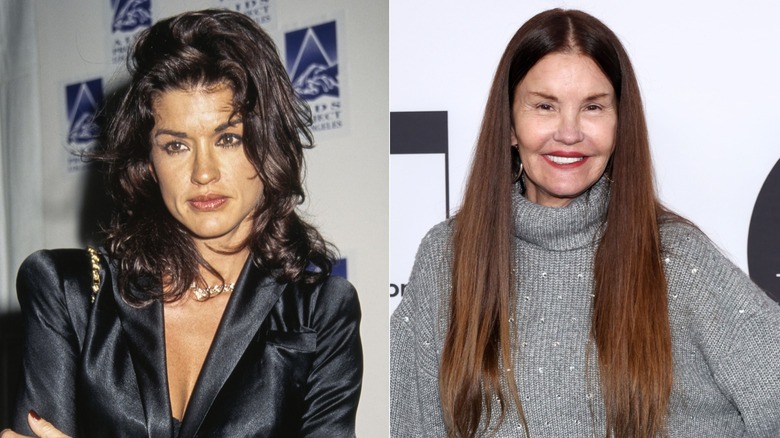 Janice Dickinson before and after plastic surgery