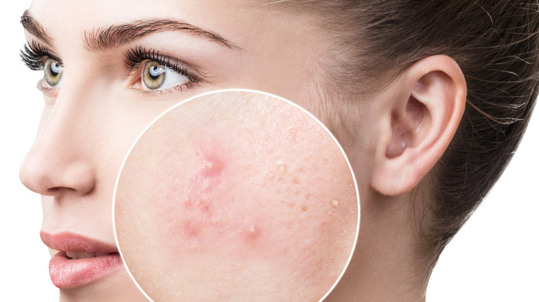 Woman with acne