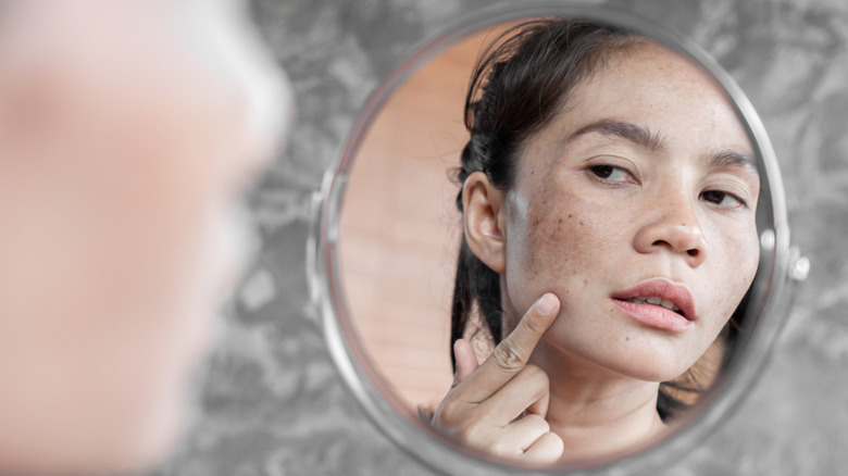 Woman with dark spots on her face