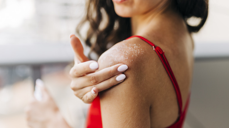 woman with sunburn on shoulder