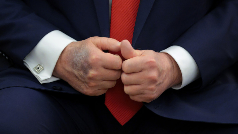 Close up on Donald Trump's hands, one has a large bruise on it.