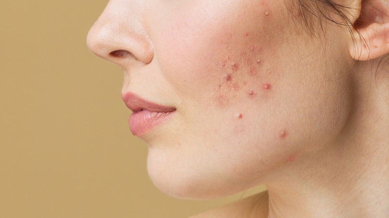 Woman with acne on skin