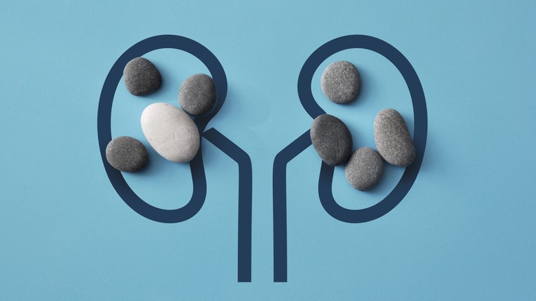 Graphic representation of kidneys with rocks on it