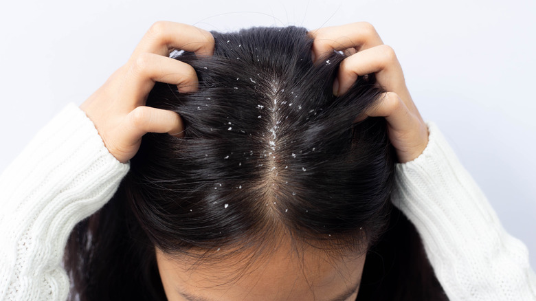 woman scratching hair with dandruff