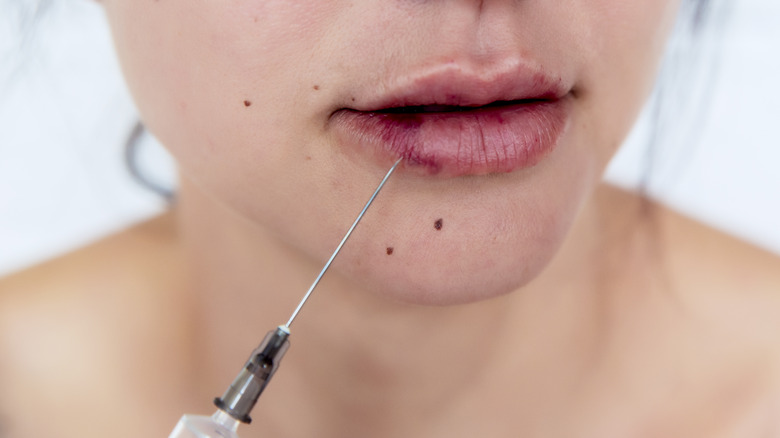 womans lips after filler