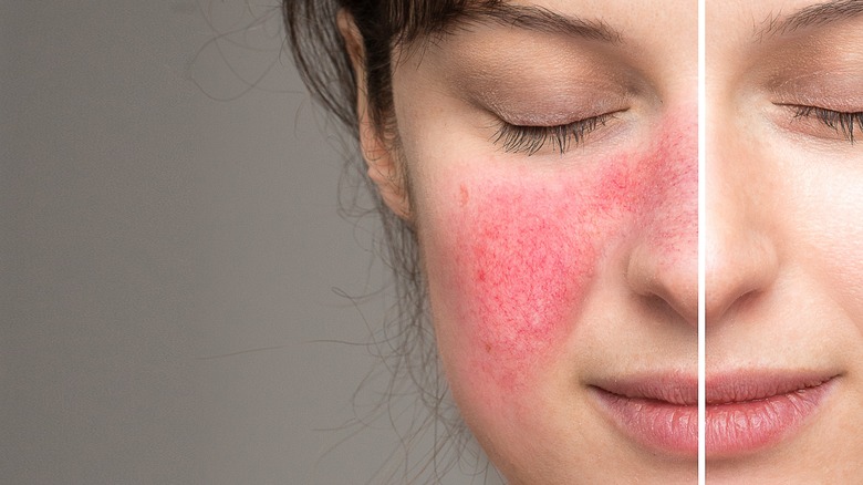 Woman with rosacea