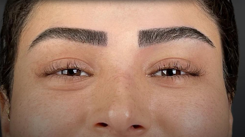 Eyebrow transplant patient