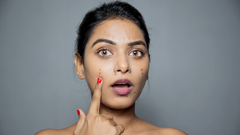 Woman with acne finger on face